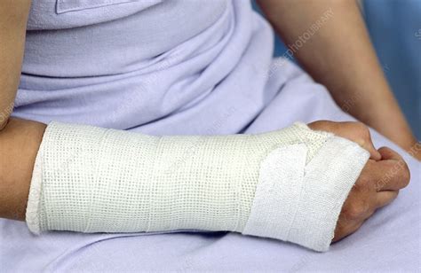 Broken Arm Stock Image M3301225 Science Photo Library