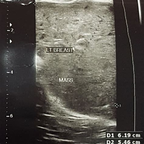 Usg Image Of The Breast Lump Showing A Large Solid Mass In Left Breast