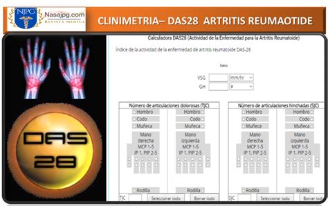 Calculadora DAS28 Actividad De La Enfermedad Para La Artritis
