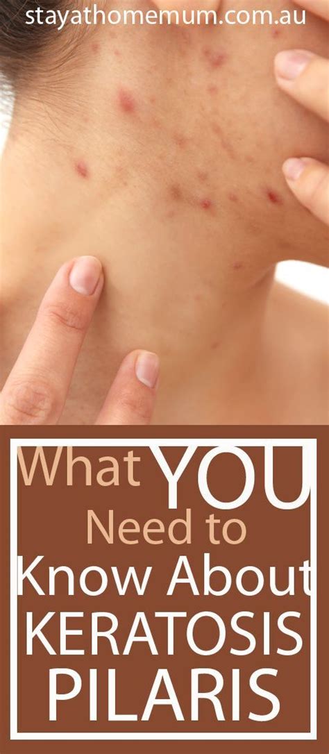 Keratosis Pilaris Is A Common But Harmless Skin Condition That Is