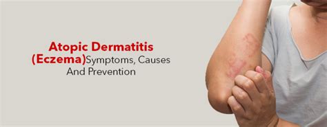 Atopic Dermatitis Eczema Symptoms Causes And Prevention Kayawell
