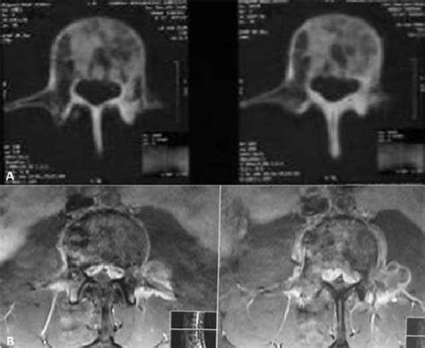 Ct A And Mr B Images Of L3 Vertebra The Mass Lesion Is Lytic In