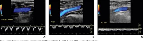 Venous Doppler Sonography Of The Extremities A Window To Off