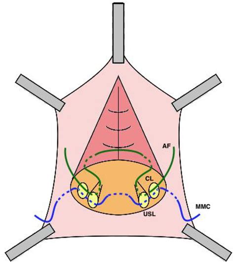 Fixation Of Uterosacral Ligaments To Anterior Vaginal Wall During