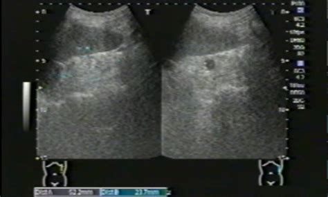 306症例目（透析腎；acdk4例） まだまだ修業中超音波検査士の今日の1症例