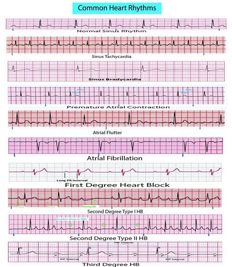 Cheat Sheet For Ekgs Images And Photos Finder