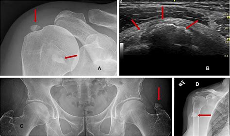 Clinical Evaluation And Management Of Calcific Tendinopathy An Evidence Based Review