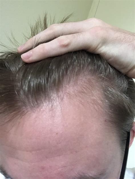 Is This Hair Loss Corner Of Hairline Thinned Out About A Year Ago And