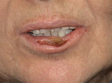 Photograph Of An Indurated Crusted Lesion With Central Ulceration