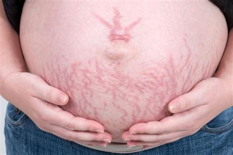 What Are Stretch Marks How Can Stretch Marks Be Treated Medical