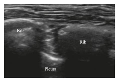 Ultrasound Image Of Intercostal Nerve Blocks A Placement Of The