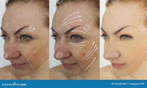 Wrinkle Eye Wrinkles Before And After Treatment Stock Image Image Of