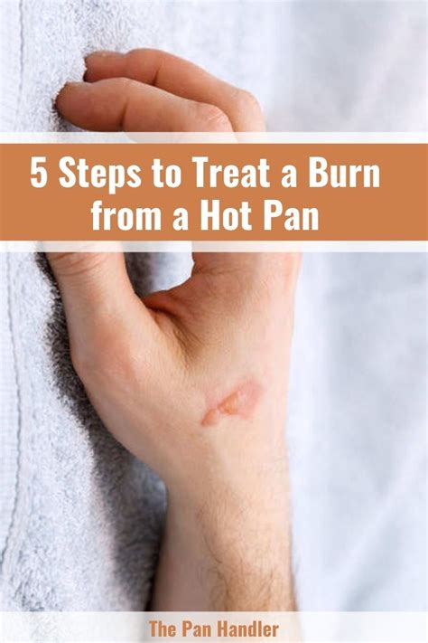 5 Steps To Treat A Burn From A Hot Pan First Aid Reminders
