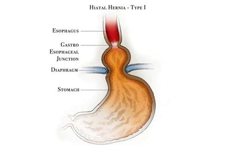 Hernia Hernia Symptoms Treatment Plan Treatment