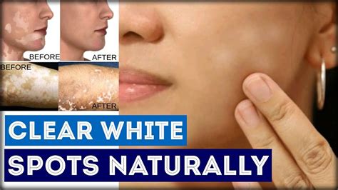 Vitiligo Leucoderma What Causes White Spots How To Clear White