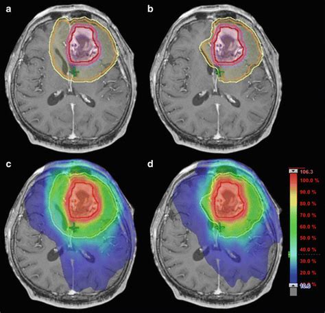 brain tumor how should we manage glioblastoma in the era of imrt radiology key