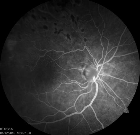 Focal Laser Photocoagulation In Ischemic Peripheral Retina In Brvo
