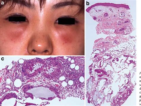 figure 1 from eosinophilic granulomatous reaction after intradermal injection of hyaluronic acid