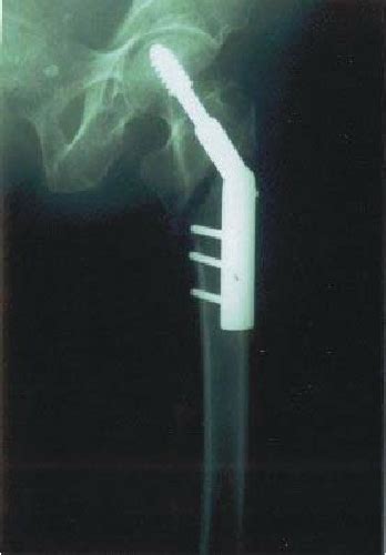 Dhs Dynamic Hip Screw After Operation Of Trochanteric Fracture