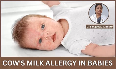 Decoding Cows Milk Protein Allergy Cmpa In Babies Dr Sangeetav Budur