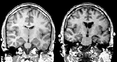Social cognition and schizophrenia / edited by corrigan p. Chronic Schizophrenia | Psychiatry Neuroimaging Laboratory