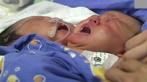 Chinese Conjoined Twins Fight For Survival