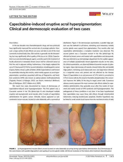 Capecitabine Induced Eruptive Acral Hyperpigmentation Clinical And