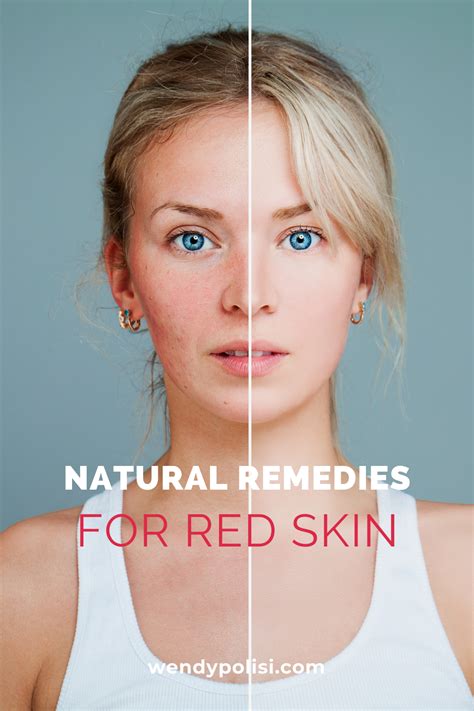 If You Are Looking For Home Remedies That Will Help To Soothe Your Red Skin Dont Miss These