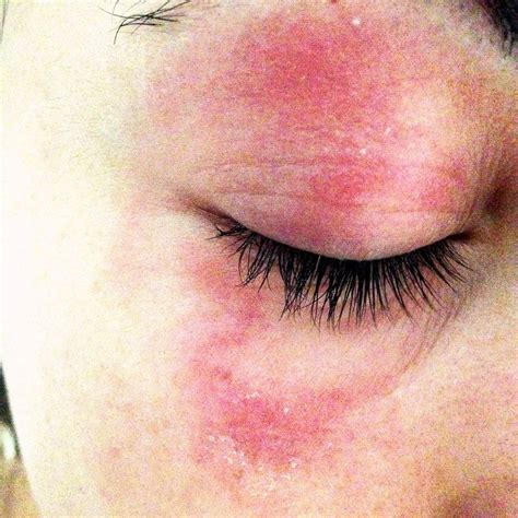 Allergic Reaction To Makeup On Face Mugeek Vidalondon