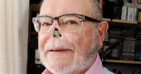 Cancer and libra really aren't a great pairing. Malignant Melanoma Cancer Leave Man With Magnetic Nose ...
