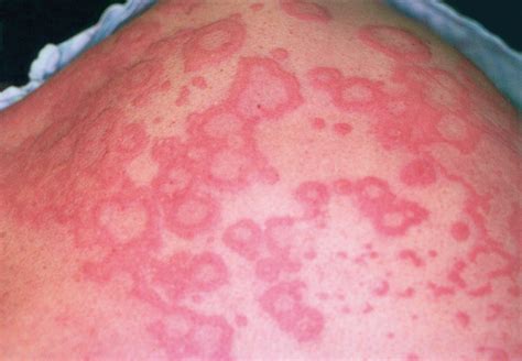 Erythema Multiforme Associated With Bupropion Use Dermatology Jama