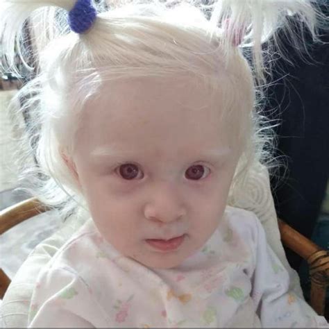 Albinism Albino Peoplewhite Hair White Eyelashes Alternative