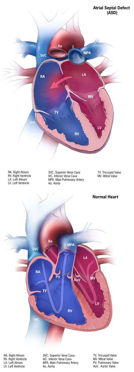 Congenital Heart Defects Facts About Atrial Septal Defects Cdc My Xxx