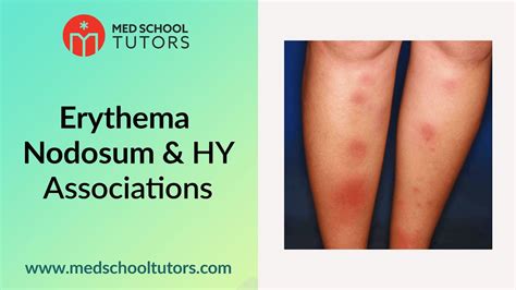 Erythema Nodosum And High Yield Associations For The Usmle Step 1 Youtube