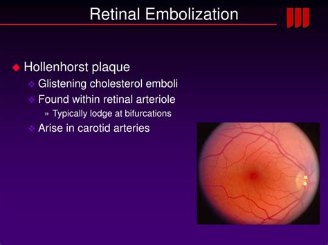 Ppt Arterial And Venous Occlusive Disease Of The Retina Powerpoint