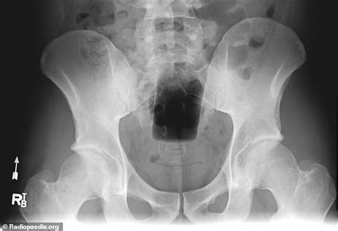 bizarre objects stuck inside people s orifices that required emergency room visits are revealed