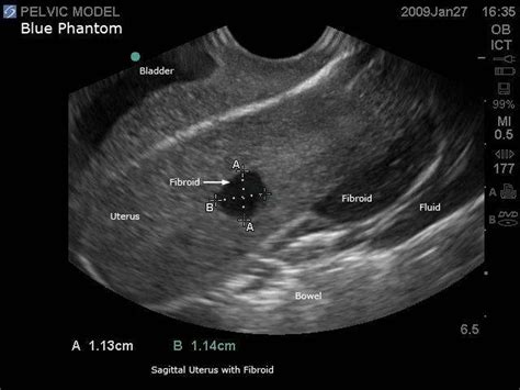 General Pathology Transvaginal Ultrasound Training Model