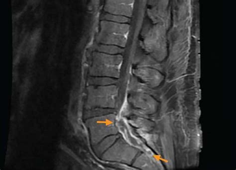 Epidural And Paraspinal Abscess Presenting As Acute Low Back Pain