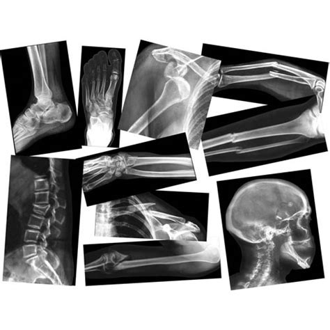 Broken Bones X Rays