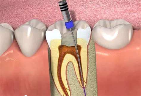 Endodontia Biologia E Técnica