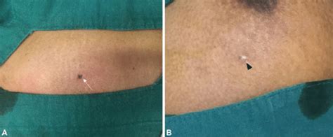 Photographs Showing The Appearance Of Vacuum Assisted Excision Biopsy