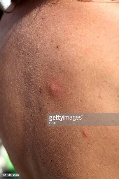 Bug Bite Adult Photos And Premium High Res Pictures Getty Images