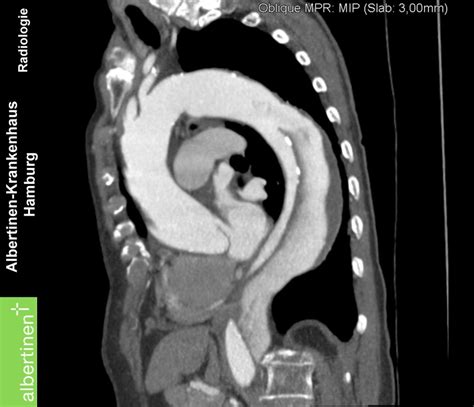 Aortic Dissection Ct Scan
