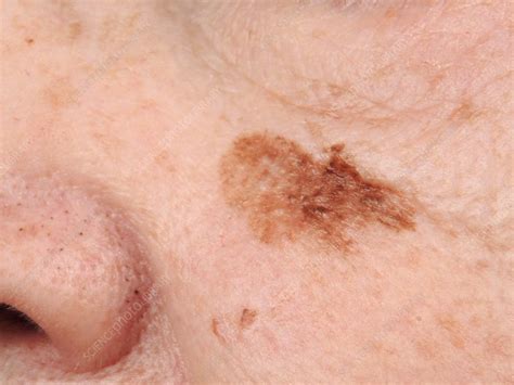 Lentigo Maligna Melanoma Stock Image C0402880 Science Photo Library