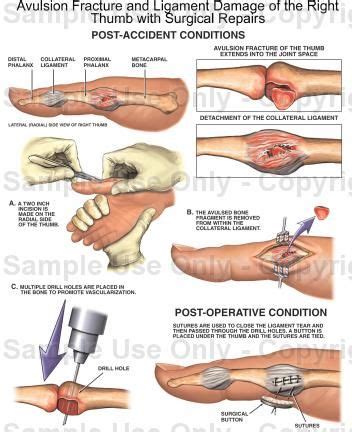 Avulsion Fracture and Ligament Damage of the Right Thumb ...