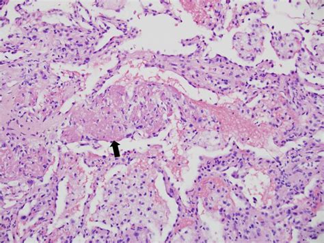 Alveolar tissue w/ terminal bronchioles, respiratory bronchioles, alveolar ducts. Case 1: Transbronchial biopsy shows lung parenchyma with intra-alveolar... | Download Scientific ...