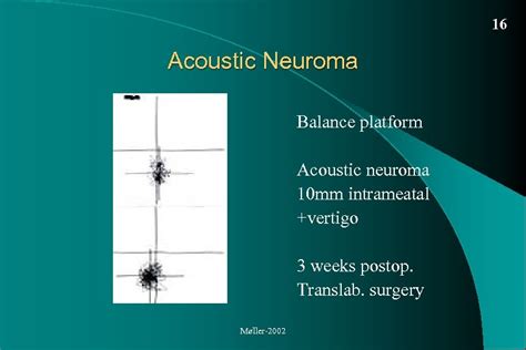 Acoustic Neuroma Vestibular Schwannoma Diagnosis And Treatment Per