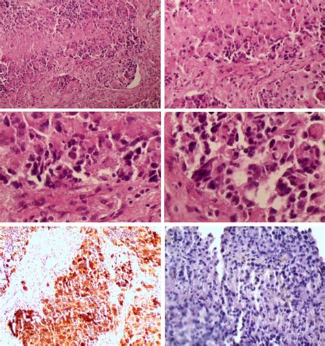 Extra‐cns Metastasis Of Glioblastoma Multiforme To Cervical Lymph Nodes