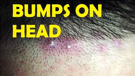 34 Razor Bumps On Head After Haircut Nazreenbreah