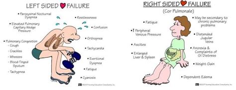 R And L Hf Heart Failure Nursing Right Sided Heart Failure Nursing
